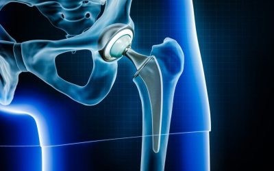 Modernizing Our Understanding of Total Hip Arthroplasty in the Pediatric and Young Adult Patient: A Single-center Experience